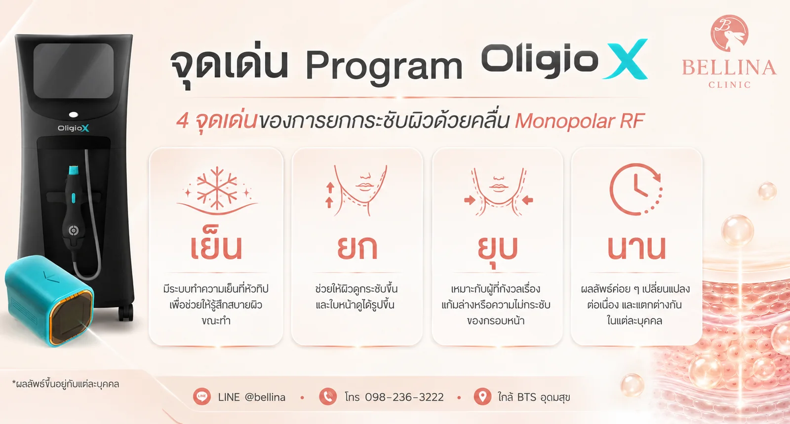 จุดเด่น Oligio X: เย็น ยก ยุบ นาน - ยกกระชับผิวด้วยคลื่น Monopolar RF